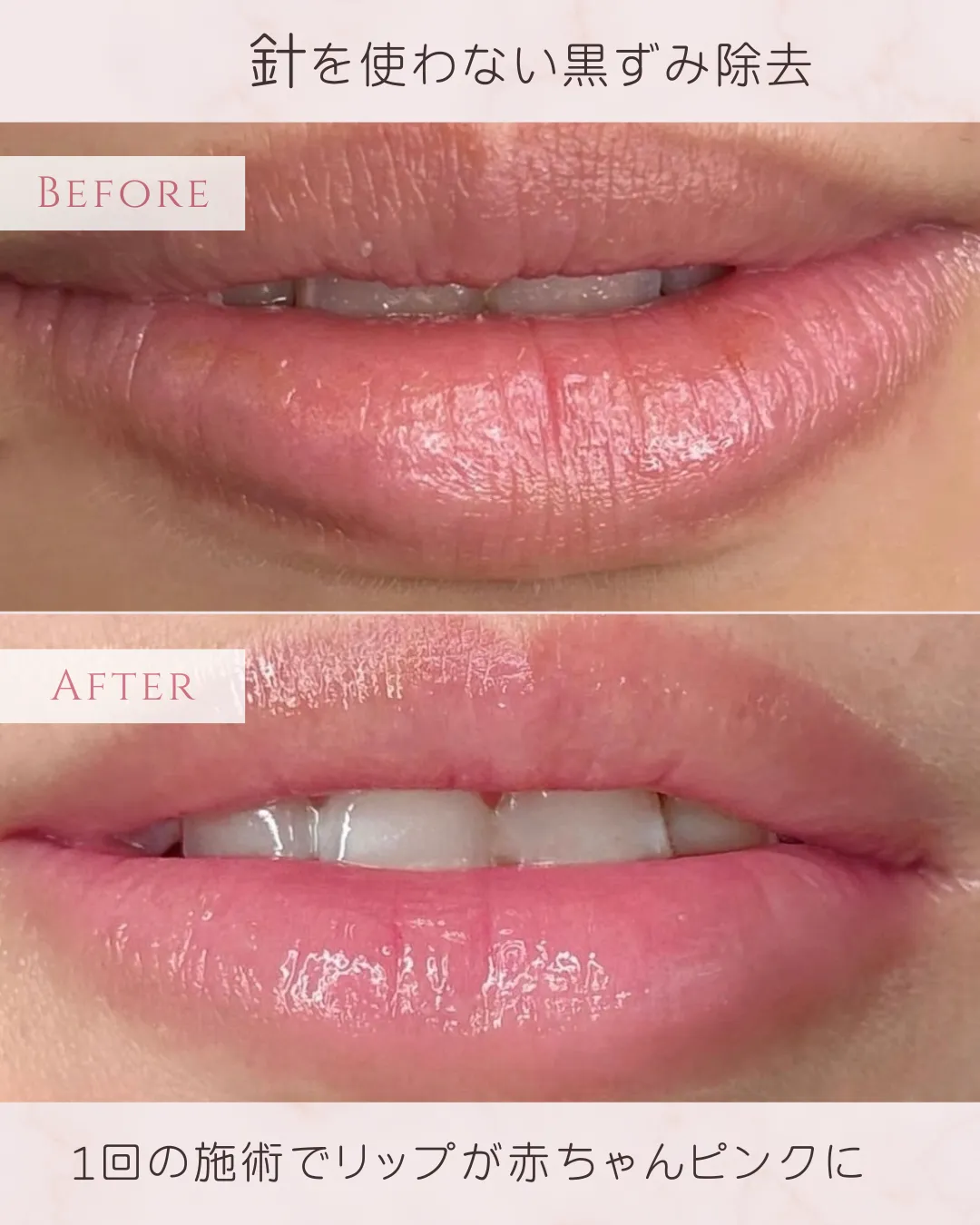 ローマピンクの人気！リップ♪キャンペーン | ブログ | 愛知県今池の