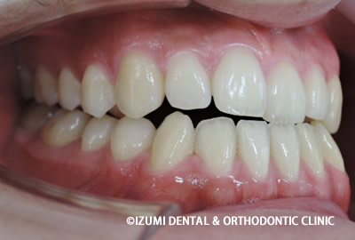 18歳男子 受け口（反対咬合/下顎前突）の非抜歯矯正 | 千葉県市川市