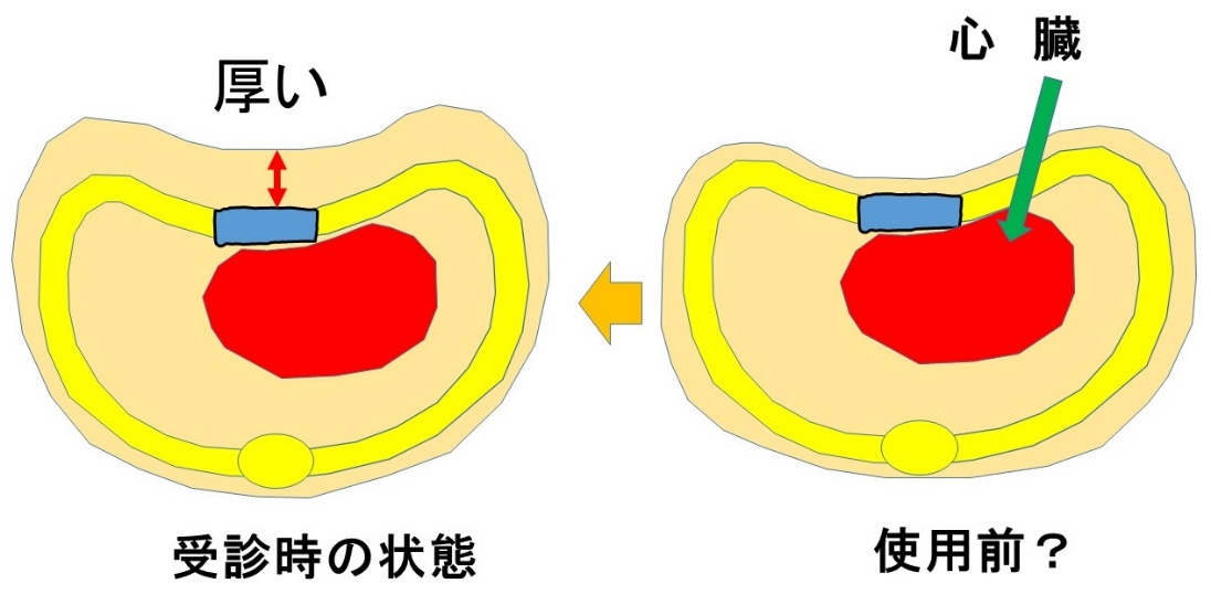 香川大学医学部形成外科・漏斗胸専門サイト「胸のかたち」研究室