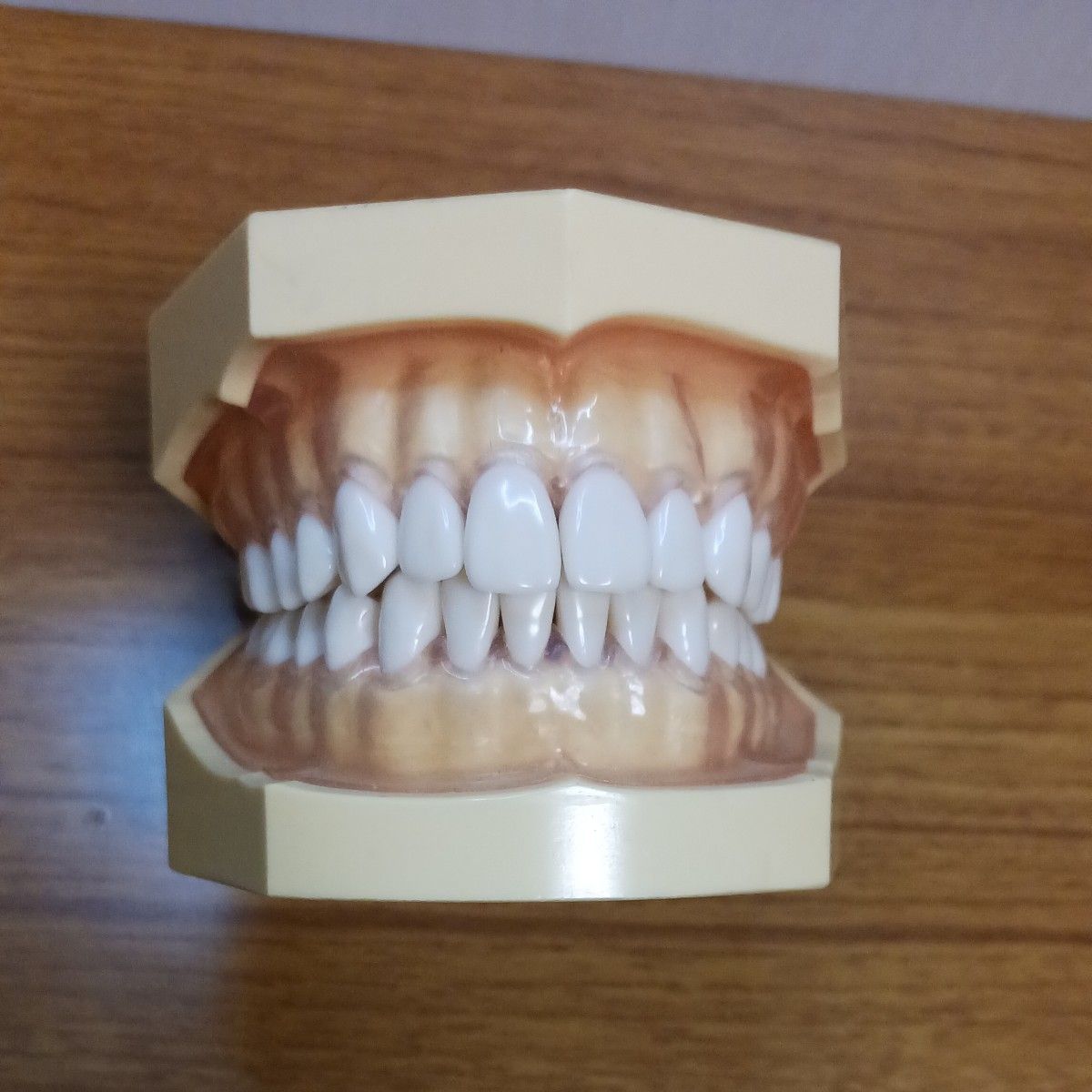 送料込 歯科 部分床義歯 金属床 パーシャルデンチャー サンプル 模型