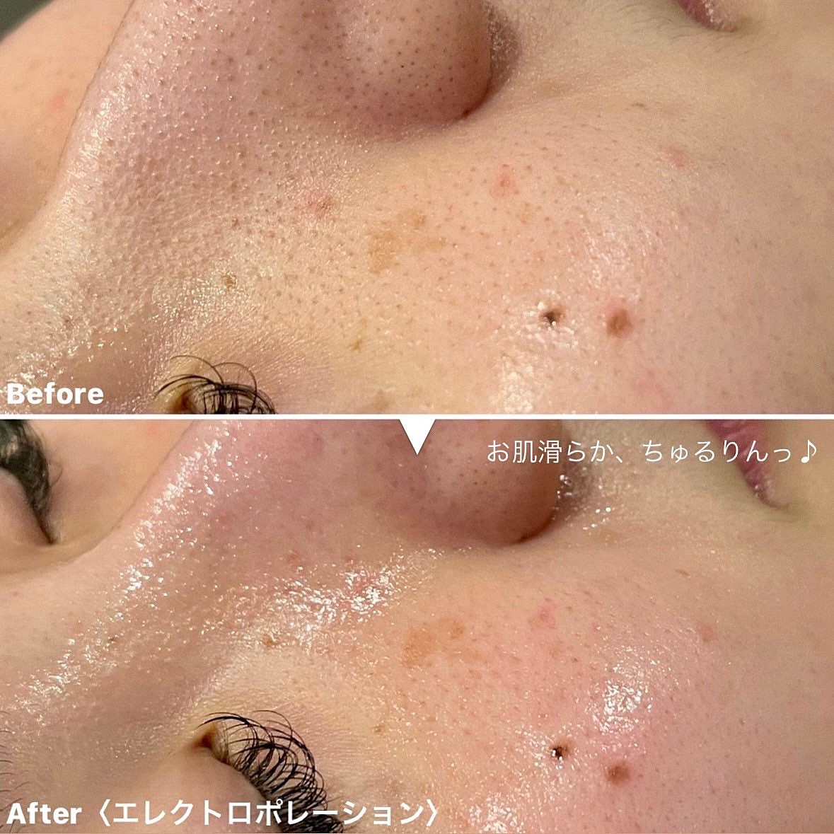 毛穴レスの肌へ】毛穴洗浄付き美容成分トリプル導入エレクトロポ