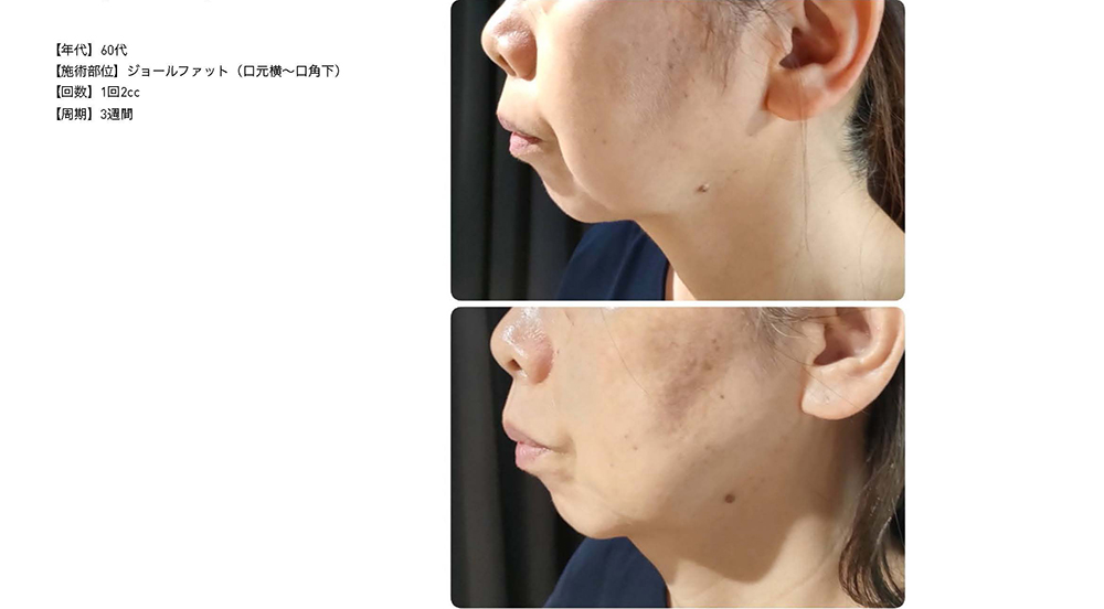 レモンボトル（10ml×5本）×10個セット 脂肪分解／脂肪溶解剤 - エステ