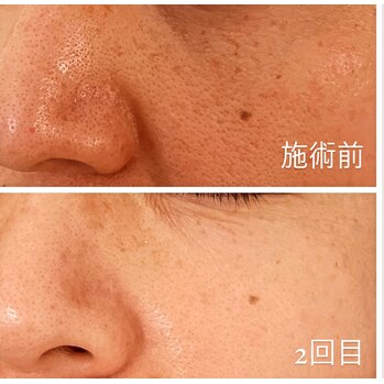 剥離あり」ハーブピーリング 2回目 | Genie（ジーニー）