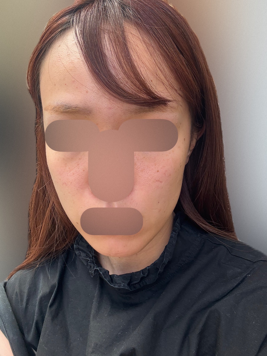 マッサージピール(全顔) | 共立美容外科 広島院