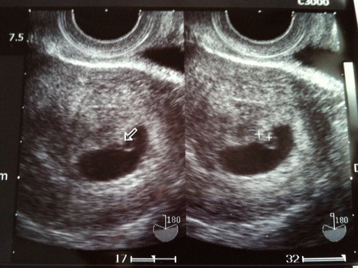 妊娠6週目のおなかの赤ちゃんはどう見える？ みんなのエコー写真・超