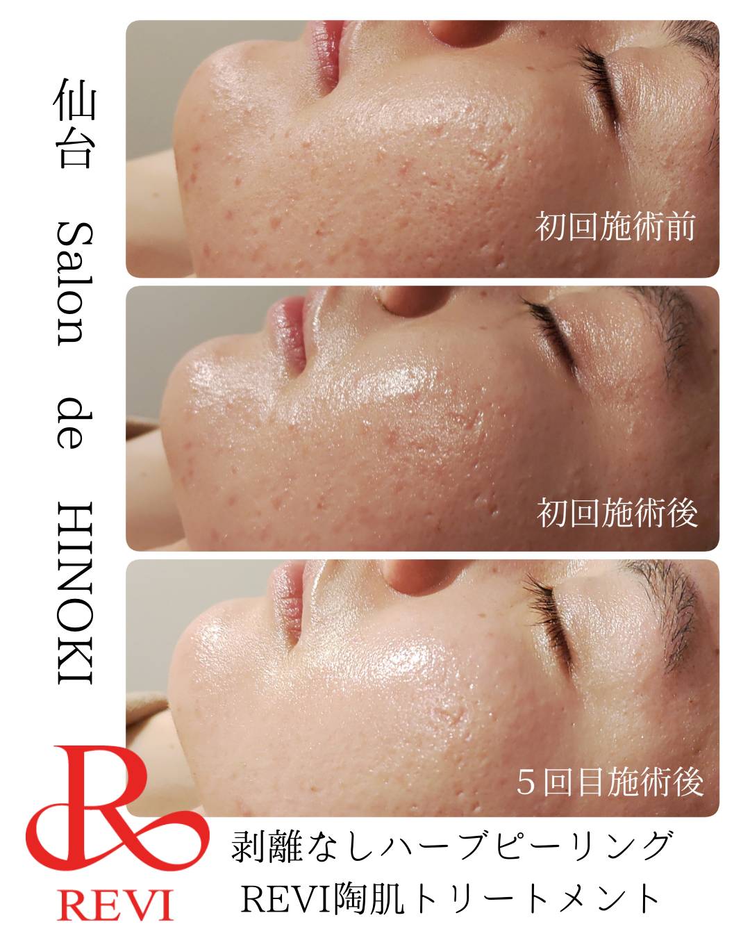 剥離なしハーブピーリング※REVI陶肌トリートメント - Salon de HINOKI