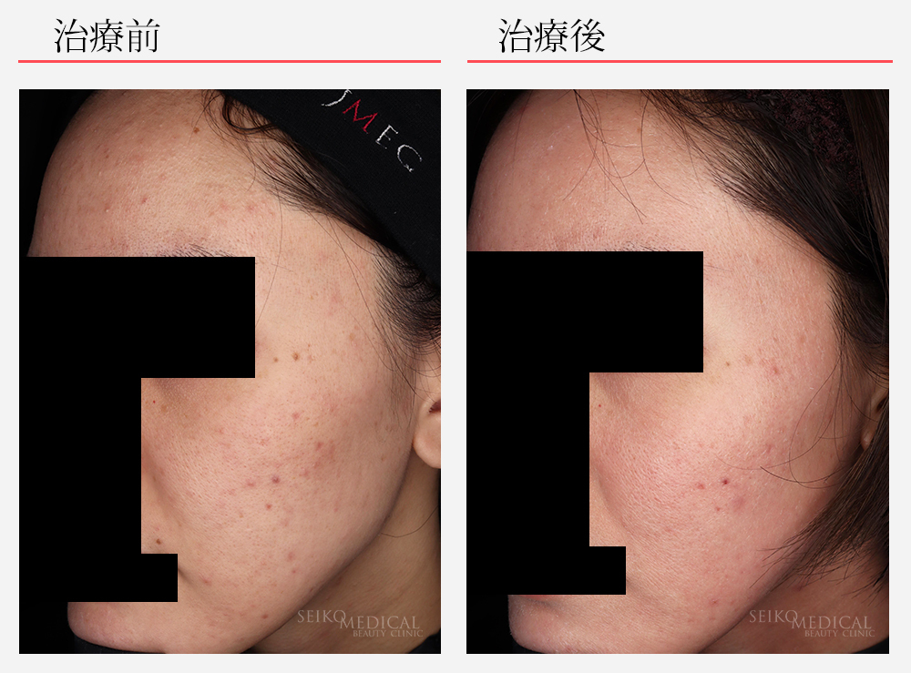 ミラミンなしのプログラム | ゼオスキンヘルス｜セイコメディカル