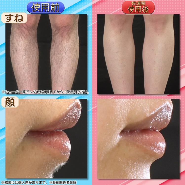 ReFa EPI GO(リファ エピ ゴー)／光美容器／ムダ毛ケア | TBS