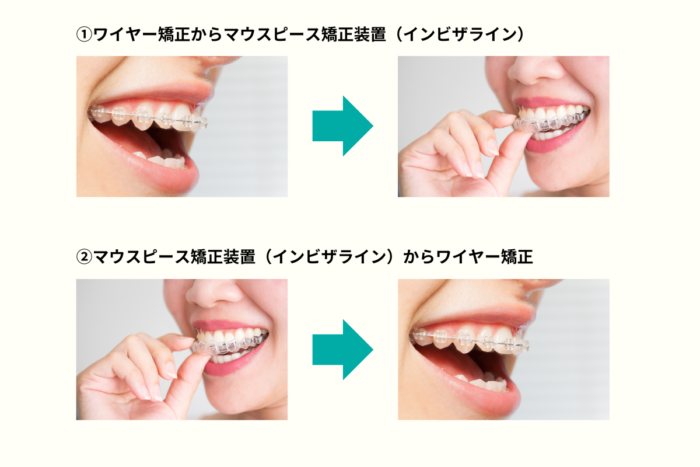 ワイヤー矯正とマウスピース矯正装置（インビザライン）を併用した歯列