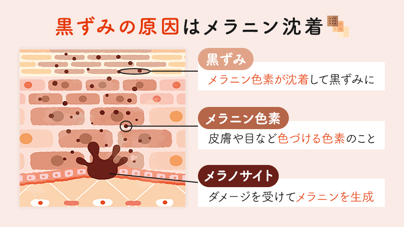 デリケートゾーンのピーリング｜新宿駅前婦人科クリニック｜黒ずみケア