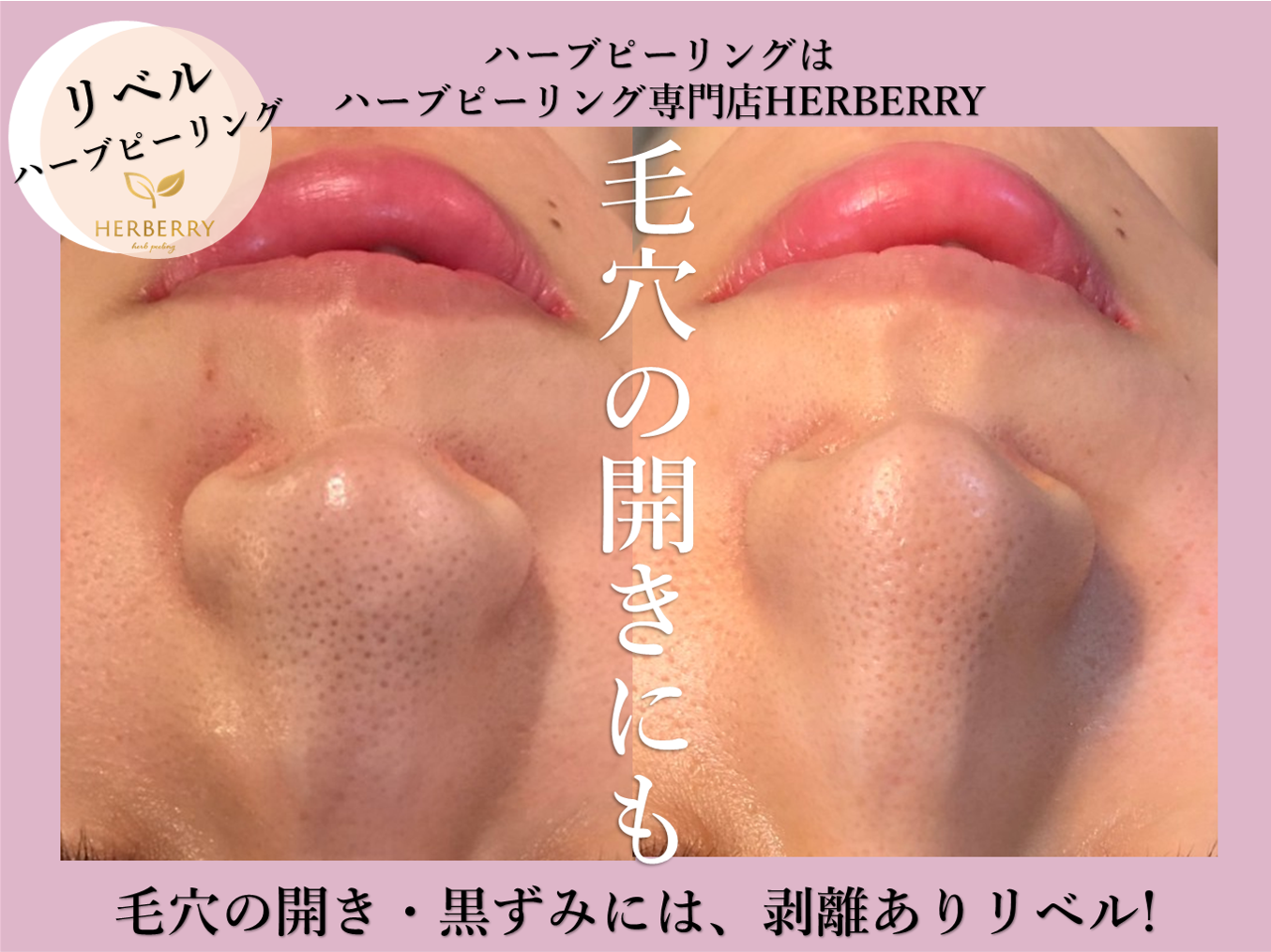 最強リベルハーブピーリング◇毛穴の開きも即解決 | ハーブピーリング